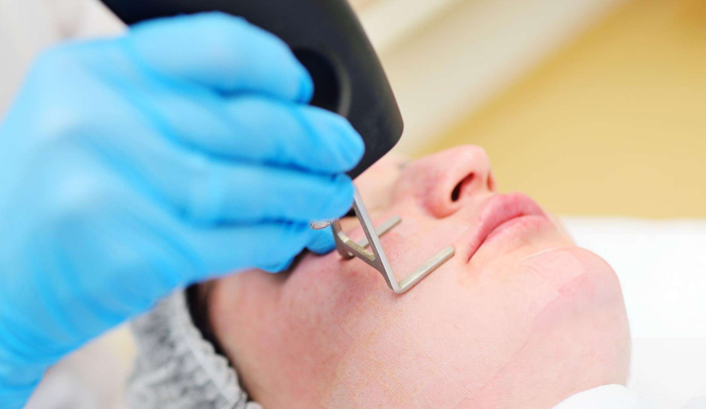 CO₂ laser treatment results